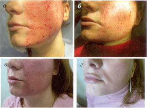 Varias etapas de la recuperación de la piel después de la cirugía de ablación. 