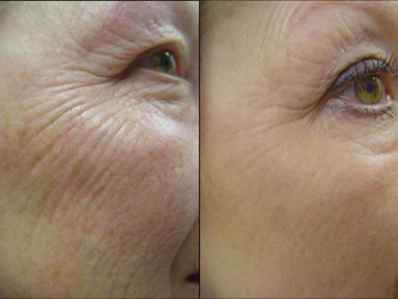 Antes y después del rejuvenecimiento cutáneo con láser reduce visiblemente las arrugas