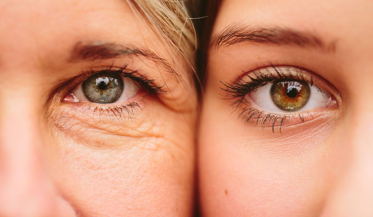 Signos de envejecimiento alrededor de los ojos. 
