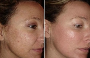 Fotos de antes y después de rejuvenecimiento facial con láser